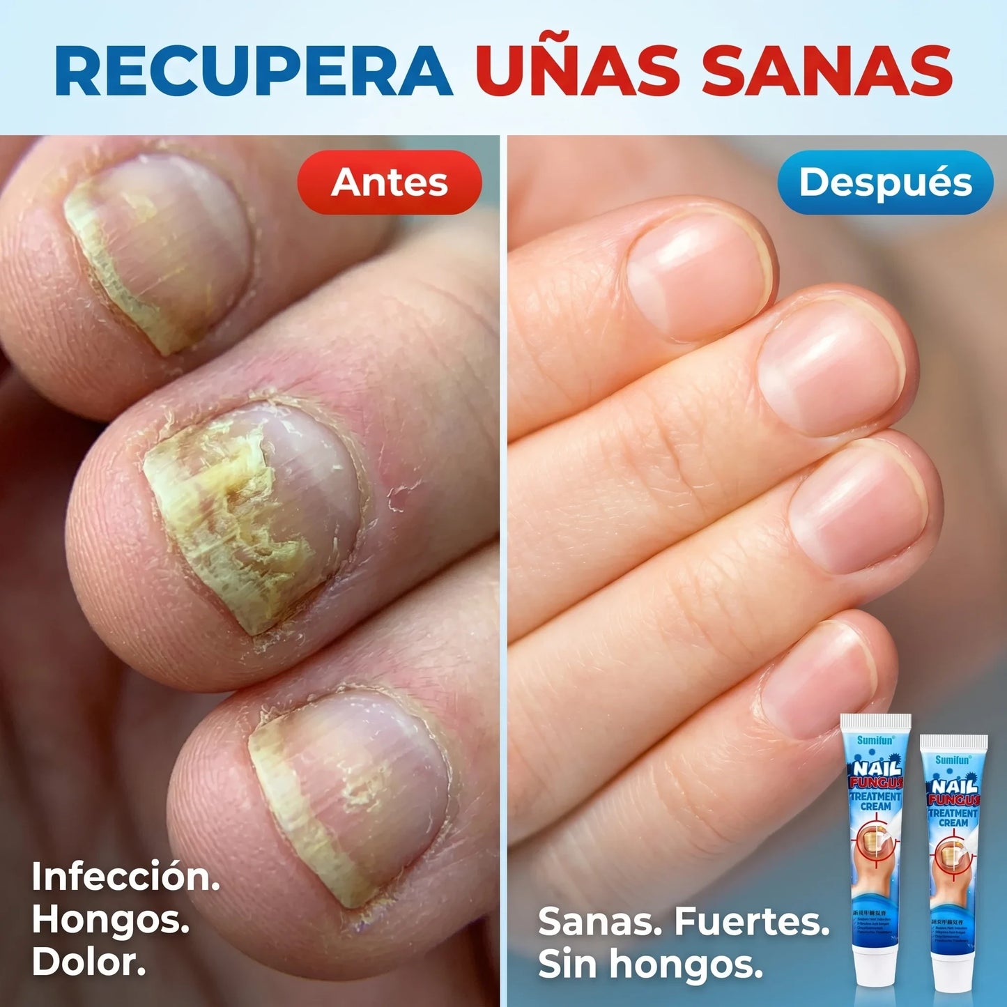 Adiós Uñas Con Hongos y Amarillas