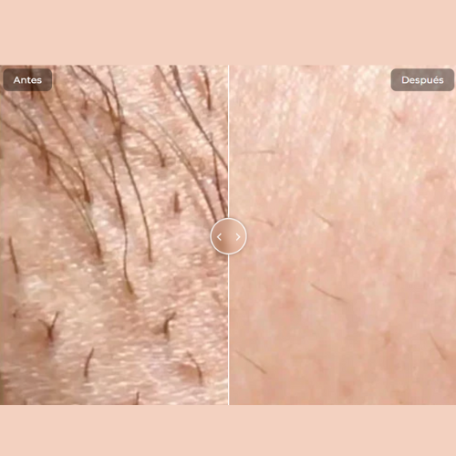 Depiladora IPL– Olvidate del rastrillo, la cera y los pelos encarnados